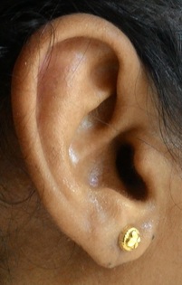 After earlobe repair with a Pardue flap
