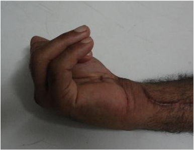Preoperative: Impaired flexion due to the adhesions surrounding the long flexors