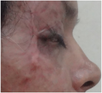 Contracture release of upper eyelid and coverage with full thickness skin graft