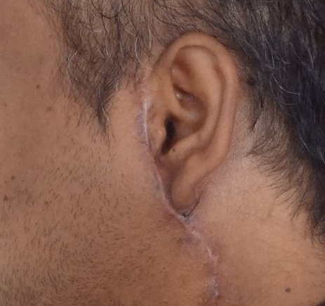 Keloid scar around ear after plastic surgery