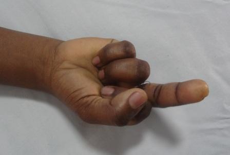 Transection of the long flexors of the middle finger