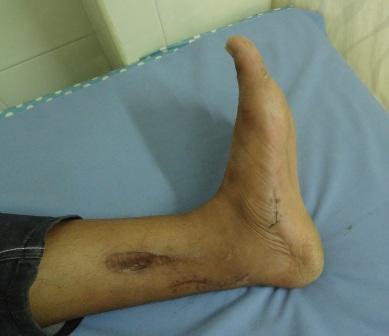 After release of the flexor of the big toe