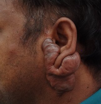 Keloid scar around ear before plastic surgery