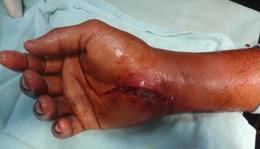 Deep laceration with transection of the ulnar nerve