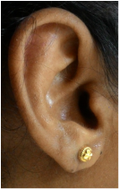 after repair of ear lobe with plastic surgery