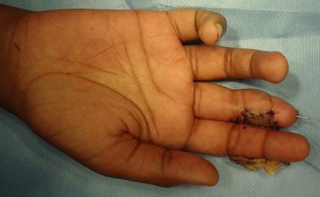 Contracture release with osteotomy, K-wire fixation and cross finger flap cover