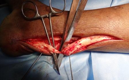 Chronic tendoachilles rupture with the instrument showing the tendon gap
