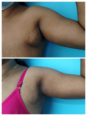 Axillary breasts before and after 