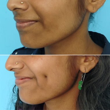 Dimple creation surgery | Before and after ure