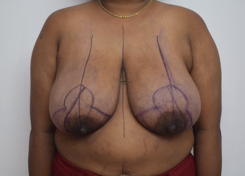 Before breast reduction (Frontal) 