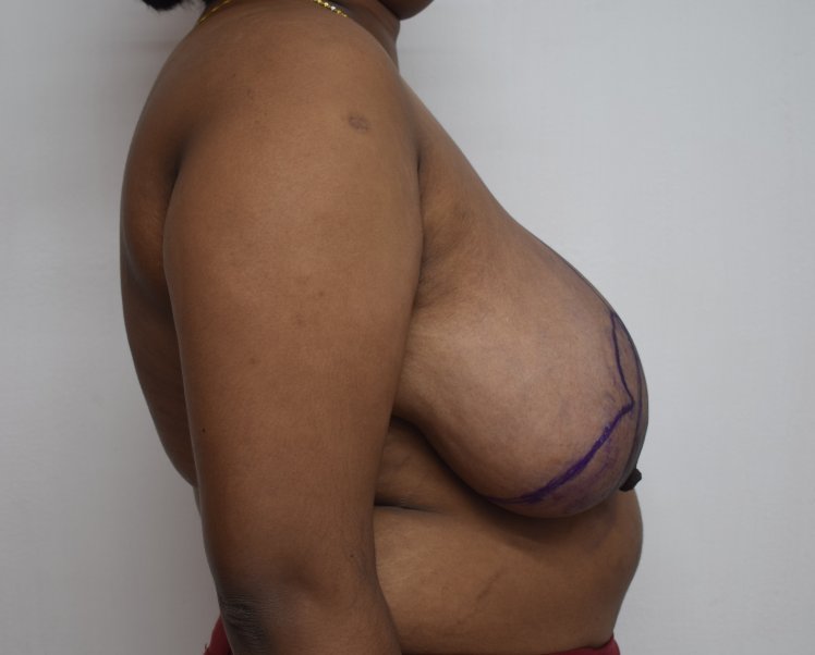 Before breast reduction (Lateral) 