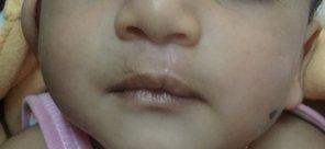 After primary correction of the cleft lip