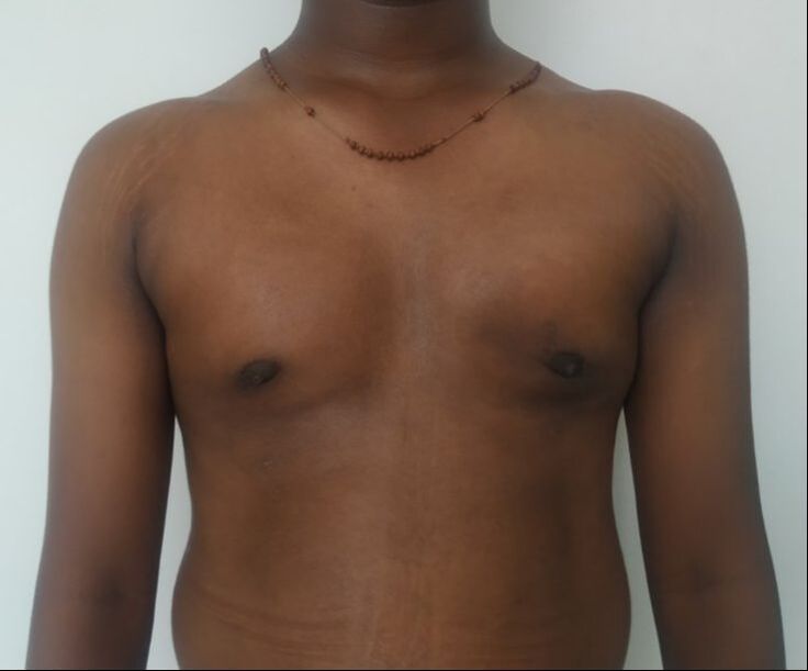 After: Early postoperative appearance at 3 weeks. Swelling is visible over the lateral aspect of the chest