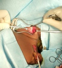 Intra-operative picture showing bipolar release of torticollis