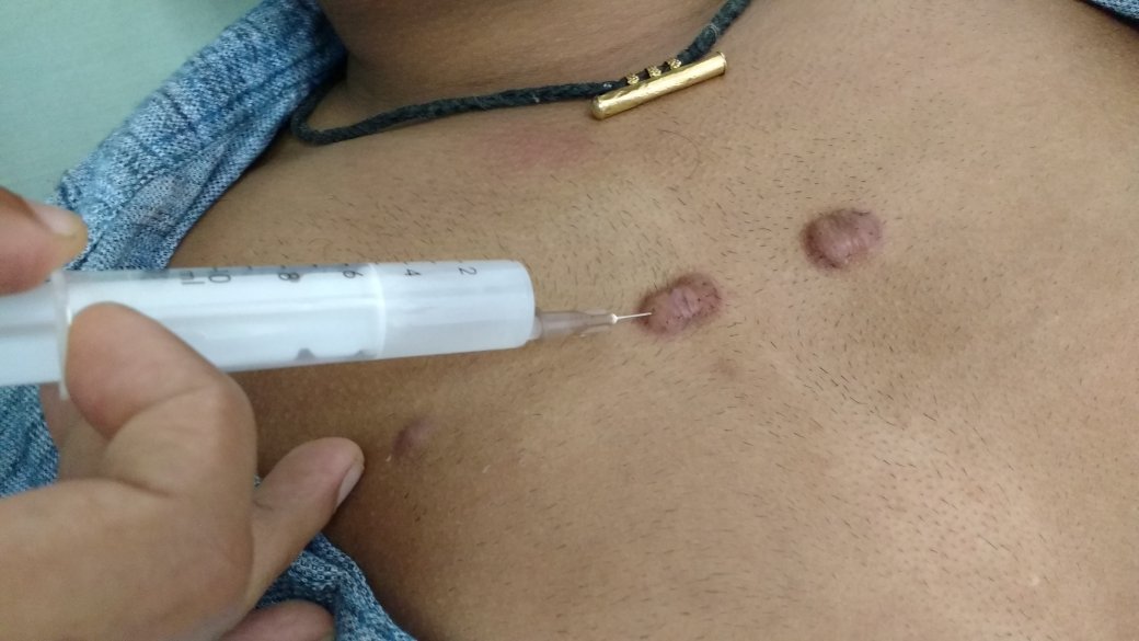Intralesional injection of steroid