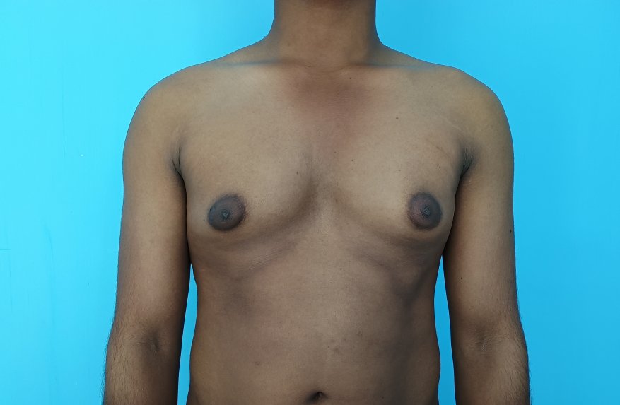 Before: Gynecomastia in an individual with mild lipodystrophy 