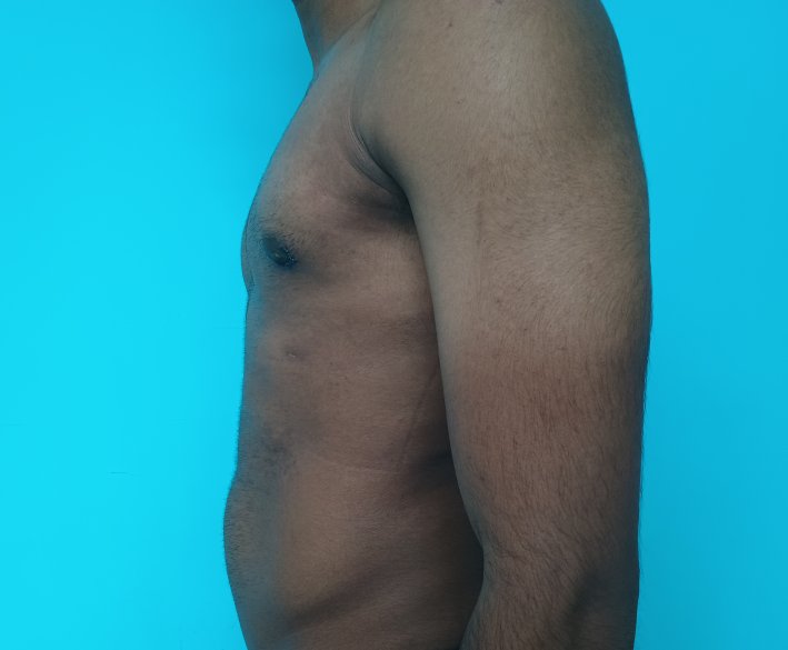 Gynecomastia treated with liposuction and direct excision through intra-areolar incision under local anesthesia.