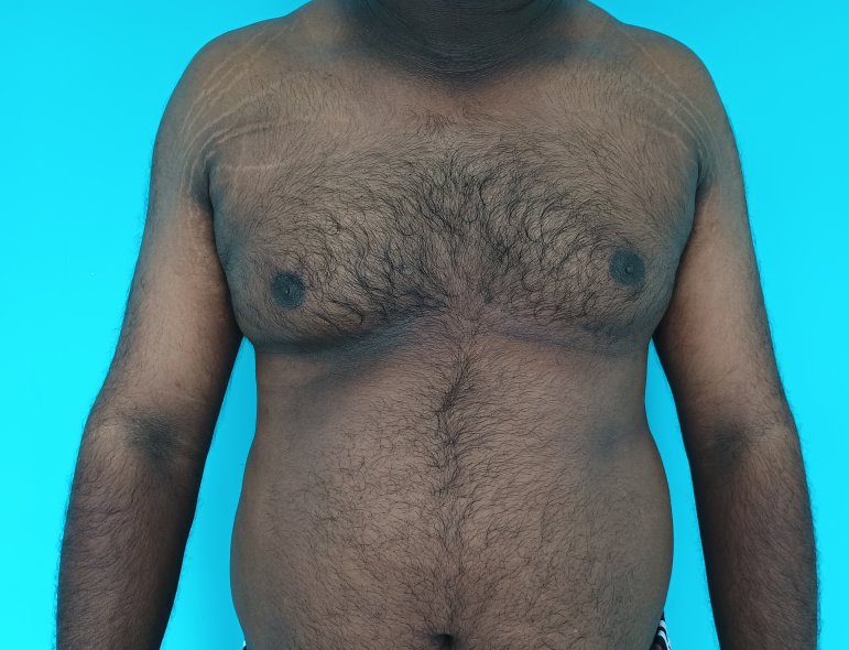 Before: Gynecomastia in a male with pendulous abdomen