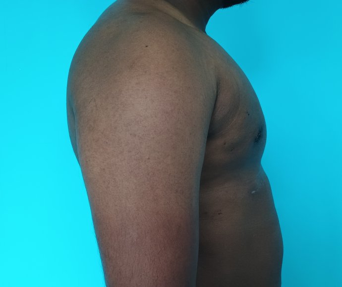 After: Liposuction and glandular excision done with an intra-areolar incision