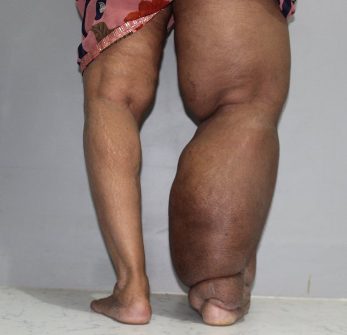 Lymphedema of the right lower limb
