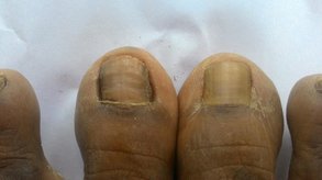Right big toe has been treated with matricectomy whereas the left is untreated