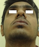 Early postoperative view with improved size of nostrils and functional improvement