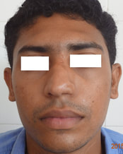 Improved balance with nasolabial flap cover and dermabrasion