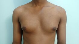 Asymmetry due to the difference in the breast tissue. 