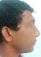 After: Secondary rhinoplasty with septoplasty, tip-plasty, dorsal augmentation and multiple osteotomies 