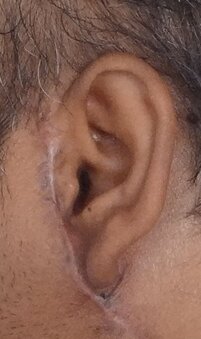 Periauricular keloid treated with serial excision and external radiotherapy