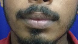 After lower lip reduction