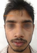 After: Rhinoplasty with asymmetric osteotomies and cartilage grafts