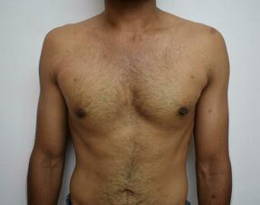 After: 6 weeks post-operative image following liposuction and gland removal using areolar incision. 