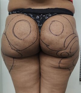 Liposuction markings of buttocks and lateral thighs (saddle bags)