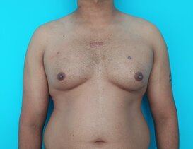 Before: Gynecomastia with moderate lipodystrophy