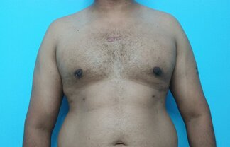 After: Liposuction and gland excision