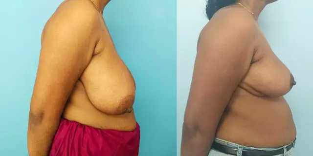 Lateral view of the above patient. Improvement in projection and nipple position is seen.