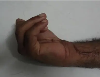 Preoperative: Impaired flexion due to the adhesions surrounding the long flexors