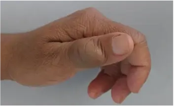 Vascular tumor of the the thumb