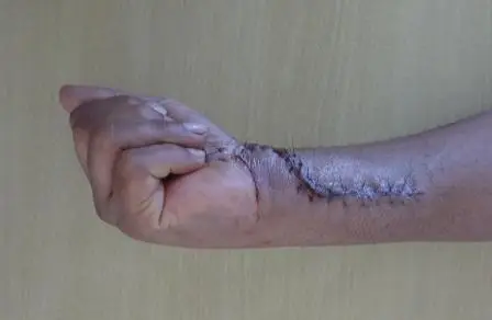 Postoperative: Improved flexion of fingers following tenolysis
