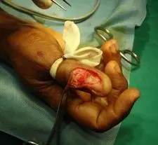 After removal of the tumor and adjacent nailbed