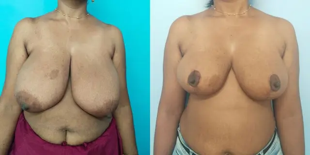 Before and after breast reduction with supero-medial pedicle. The upward positioning of the nipple areola complex is appreciated from its distance from the naevus (hyperpigmented patch) on the right breast.