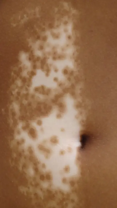 Leukoderma (white patch) of the abdomen
