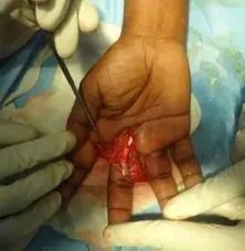 Repair of the long flexor with preservation of the pulley