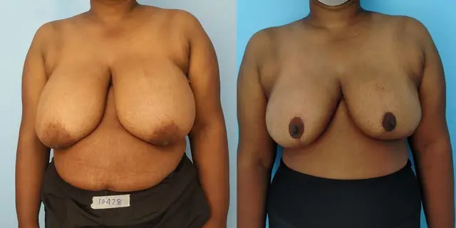 Before and after reduction mammaplasty with medial pedicle. This pedicle helps avoid a boxy deformity.