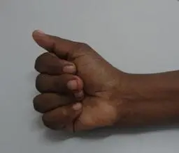 Postoperative image with good flexion of the middle finger