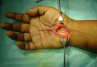 Carpal tunnel surgery with release of transverse carpal ligament