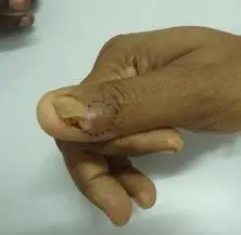 Recurrent glomus tumor of thumb