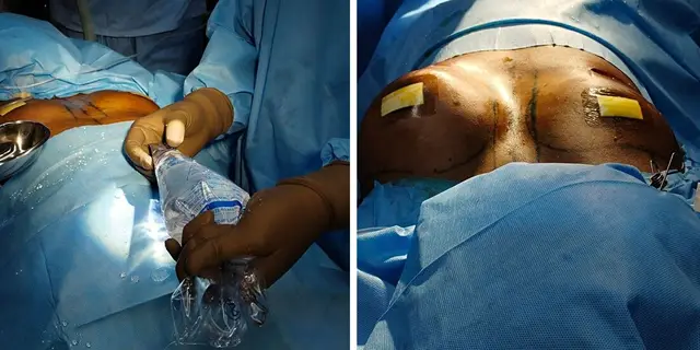 An implant loaded in a Keller funnel | Appearance after a one sided implant placement