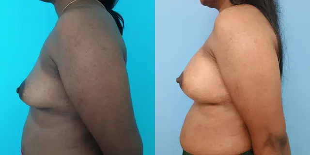 Breast augmentation with silicone implants in the sub-mammary plane | Lateral view